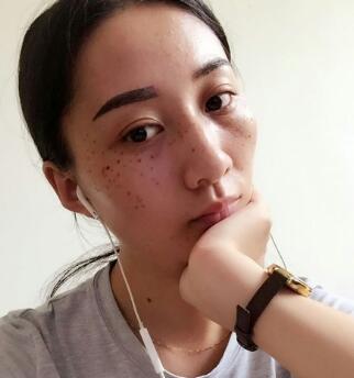 有誰做過激光祛雀斑？個人激光祛雀斑后恢復日記分享