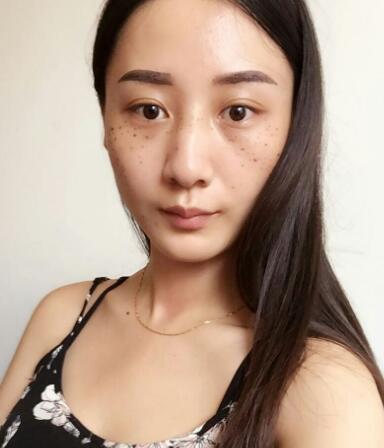 有誰做過激光祛雀斑？個人激光祛雀斑后恢復日記分享