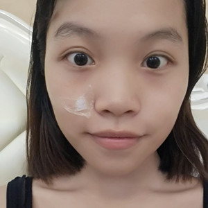 ?？诩t妝李杰醫(yī)生給我做的激光點痣，分享一下前后對比圖片