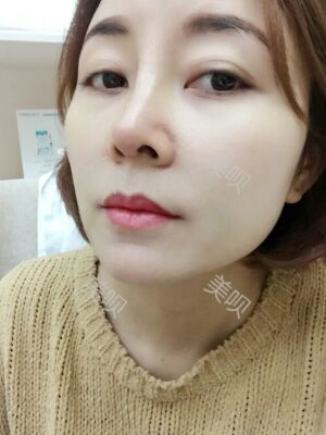 成都隆鼻整形整真實恢復(fù)圖片，終于有了韓式小翹鼻