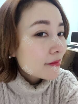 成都隆鼻整形整真實恢復(fù)圖片，終于有了韓式小翹鼻