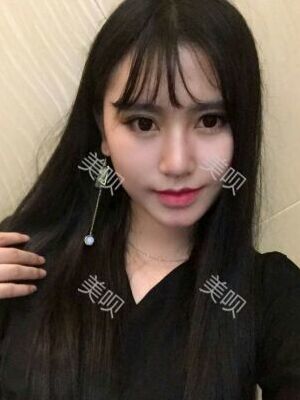 線D隆鼻恢復過程圖片，真實案例照片