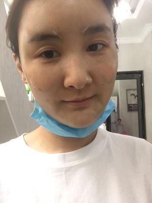 邯鄲雅乾侯德勝自體脂肪豐蘋果肌真實(shí)案例：附上前后對比圖片~