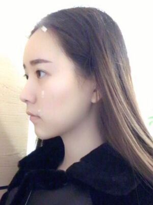 自體脂肪詳細部填充日記，恢復過程分享