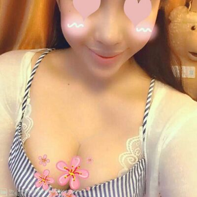 自體脂肪豐胸對比照片，福州愛美爾張勝利做的