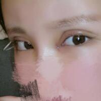 開(kāi)內(nèi)眼角割雙眼皮恢復(fù)全過(guò)程和圖片分享