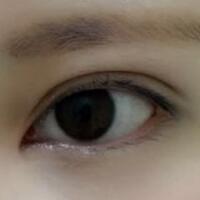 開(kāi)內(nèi)眼角割雙眼皮恢復(fù)全過(guò)程和圖片分享