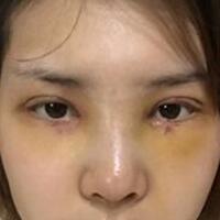 做了割雙眼皮和開(kāi)內(nèi)眼角雙眼皮多項(xiàng)整形整形手術(shù)，恢復(fù)圖片日志分享