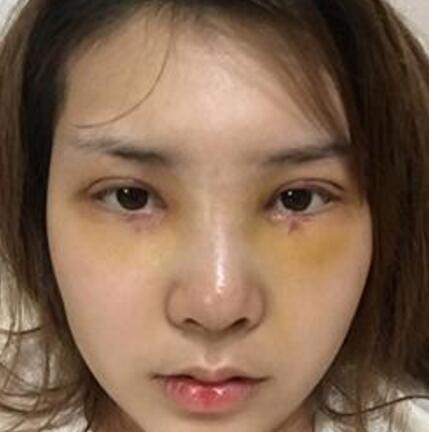 做了割雙眼皮和開內眼角雙眼皮多項整形整形手術，恢復圖片日志分享