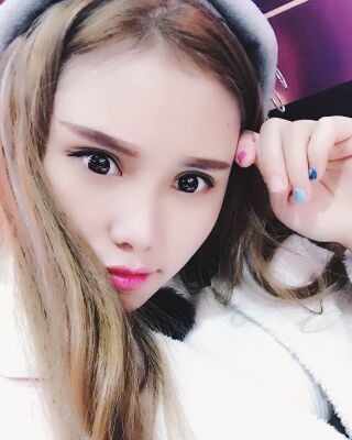 雙眼皮失敗修復(fù)果圖，福州愛美爾王召克做的