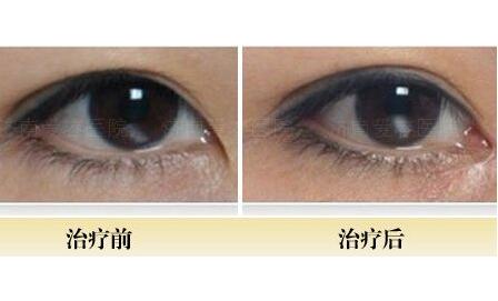 開內(nèi)眼角前后對比圖，眼睛整形價格
