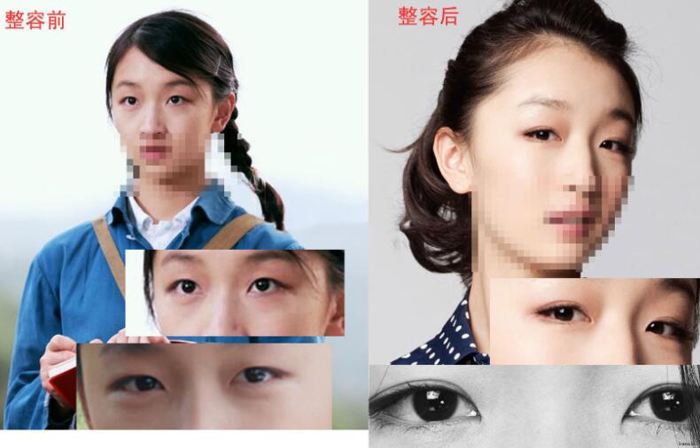 周冬雨割單眼皮前后對(duì)比圖，單眼皮割雙眼皮價(jià)格和果圖