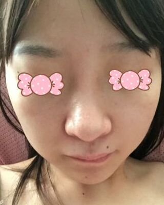 第(一)次激光去雀斑果圖，貴陽美萊劉紅武做的