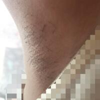 激光脫毛的價(jià)格380元，圖片分享