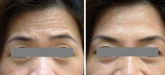 去抬頭紋前后對(duì)比圖，去抬頭紋手術(shù)多少錢(qián)？