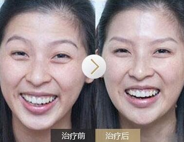 去抬頭紋前后對(duì)比圖，去抬頭紋手術(shù)多少錢(qián)？