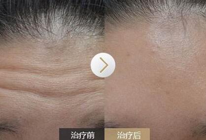 去抬頭紋前后對(duì)比圖，去抬頭紋手術(shù)多少錢(qián)？