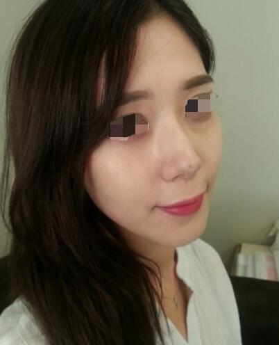 果酸嫩膚多少錢？我做成890元，果圖分享給大家