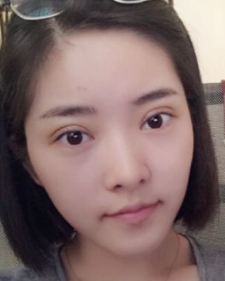 全切微創(chuàng)雙眼皮恢復(fù)圖，長(zhǎng)沙希美蔣松林手術(shù)案例