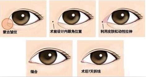 開(kāi)內(nèi)眼角原理圖，開(kāi)眼角大約多少錢(qián)