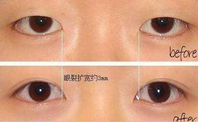開(kāi)內(nèi)眼角+割雙眼皮，開(kāi)眼角多少錢(qián)