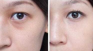 超聲波去眼袋前后對比圖，超聲波去眼袋多少錢？