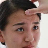 注射瘦臉去抬頭紋眉間紋恢復(fù)過程圖，真實(shí)案例分享