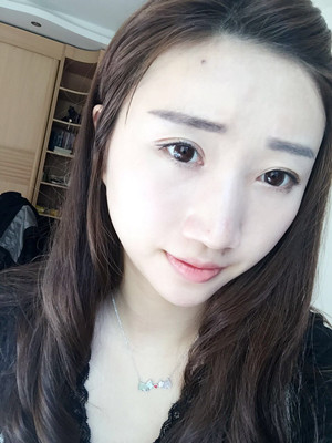 濰坊華美童艷梅醫(yī)生做的面部脂肪填充，大家來(lái)看看果怎么樣
