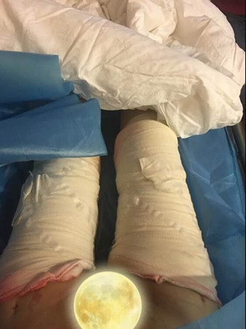 廣州美萊羅延平做的大腿環(huán)吸整形恢復果過程案例