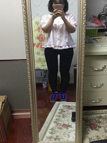 廣州美萊羅延平做的大腿環(huán)吸整形恢復果過程案例