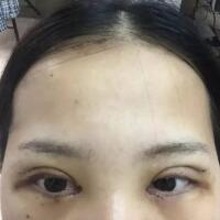 切開雙眼皮+開眼角前后對比圖和恢復(fù)過程分享