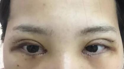 切開雙眼皮+開眼角前后對比圖和恢復(fù)過程分享