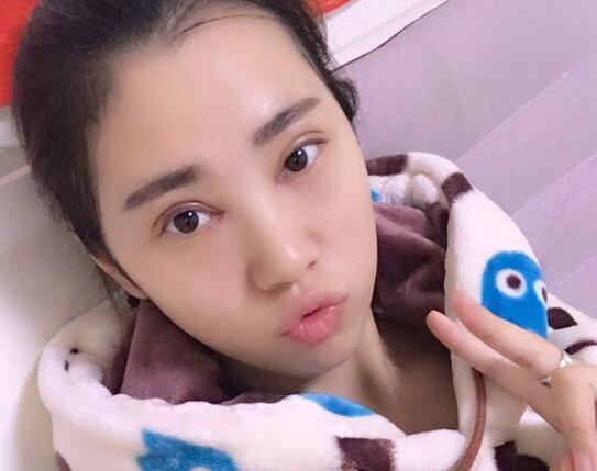 開眼角+割雙眼皮真實案例前后對比圖分享——四川悅好整形