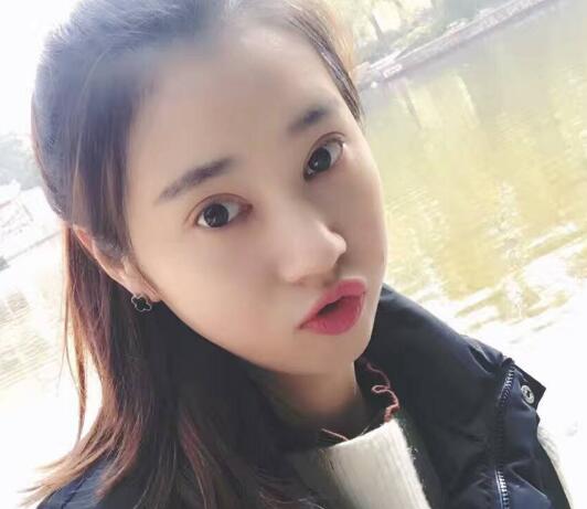 開眼角+割雙眼皮真實案例前后對比圖分享——四川悅好整形