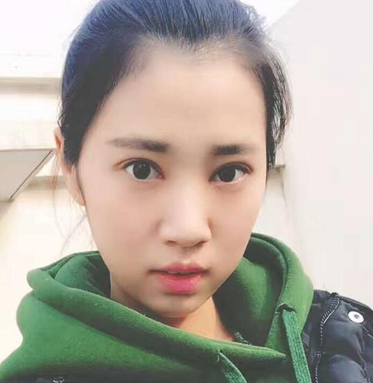開眼角+割雙眼皮真實案例前后對比圖分享——四川悅好整形