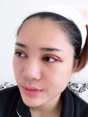 洛陽維多利亞歐式雙眼皮手術(shù)恢復(fù)過程圖，真實(shí)案例圖