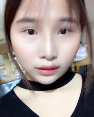 仇侃敏韓式隆鼻整形恢復(fù)果對比照片