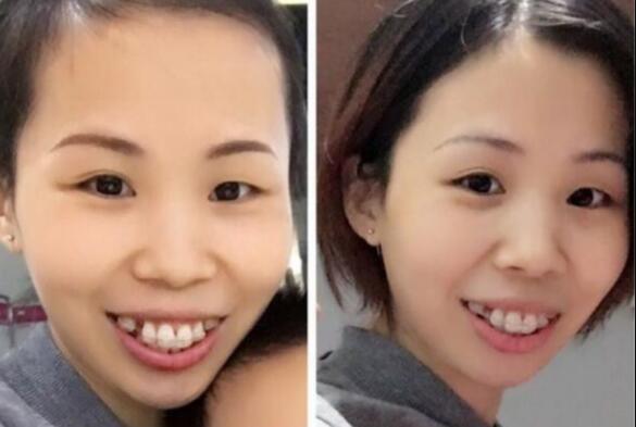 牙齒矯正的很好的年齡，多對(duì)比圖真實(shí)案例分享——成都格林口腔