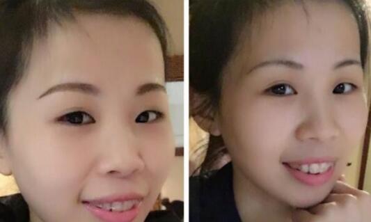 牙齒矯正的很好的年齡，多對(duì)比圖真實(shí)案例分享——成都格林口腔