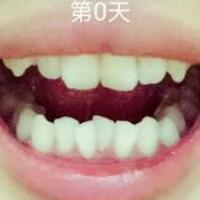 成人牙齒矯正費(fèi)用9800元——成都格林口腔醫(yī)院