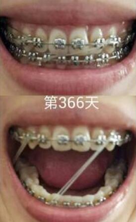 牙齒矯正前后對比圖,成人牙齒矯正費(fèi)用9800元——成都格林口腔醫(yī)院