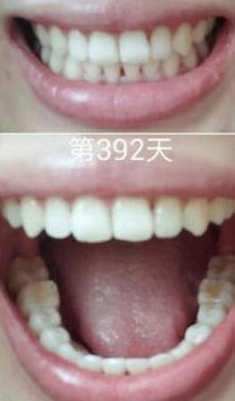 牙齒矯正前后對比圖,成人牙齒矯正費(fèi)用9800元——成都格林口腔醫(yī)院
