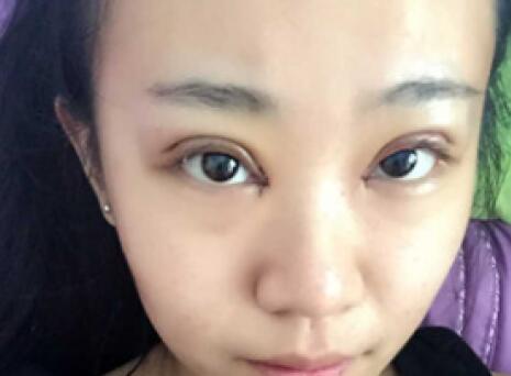 單眼皮變雙眼皮整形恢復(fù)過程和對(duì)比圖分享