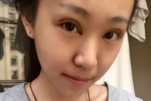 單眼皮變雙眼皮整形恢復(fù)過程和對(duì)比圖