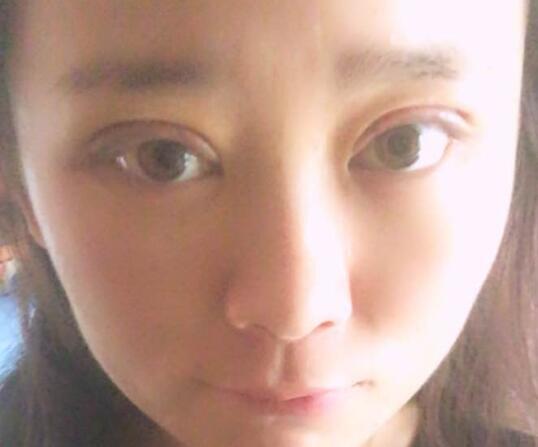割雙眼皮前后對比圖和恢復(fù)過程