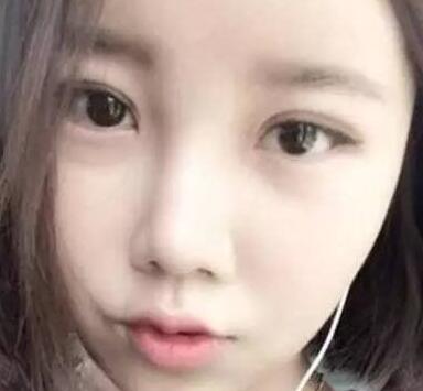 雙眼皮整形前后對(duì)比圖，單眼皮變雙眼皮整容日記