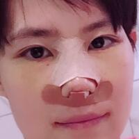 杭州悅可整形醫(yī)院做隆鼻失敗修復(fù)恢復(fù)過程和對比圖分享