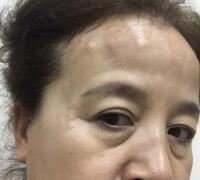 去抬頭紋方法？杭州悅可整容推薦注射瘦臉去抬頭紋魚(yú)尾紋