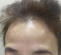 去抬頭紋方法？杭州悅可整容推薦注射瘦臉去抬頭紋魚(yú)尾紋