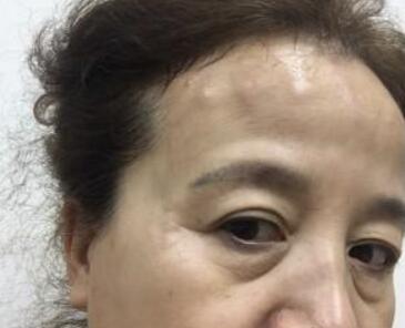 去抬頭紋很好的方法？注射瘦臉去抬頭紋魚尾紋